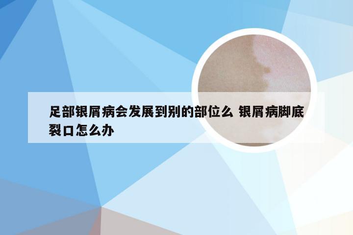 足部银屑病会发展到别的部位么 银屑病脚底裂口怎么办