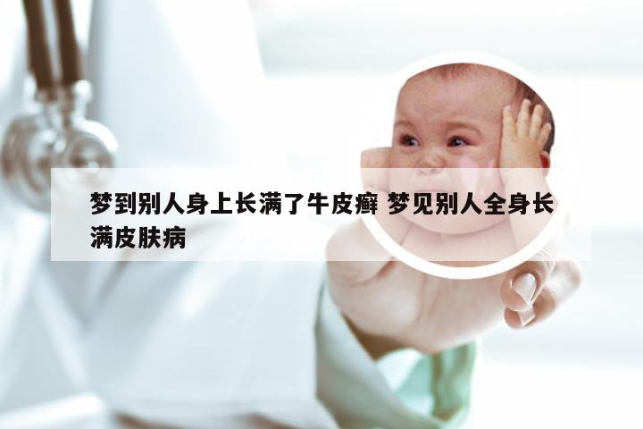梦到别人身上长满了牛皮癣 梦见别人全身长满皮肤病