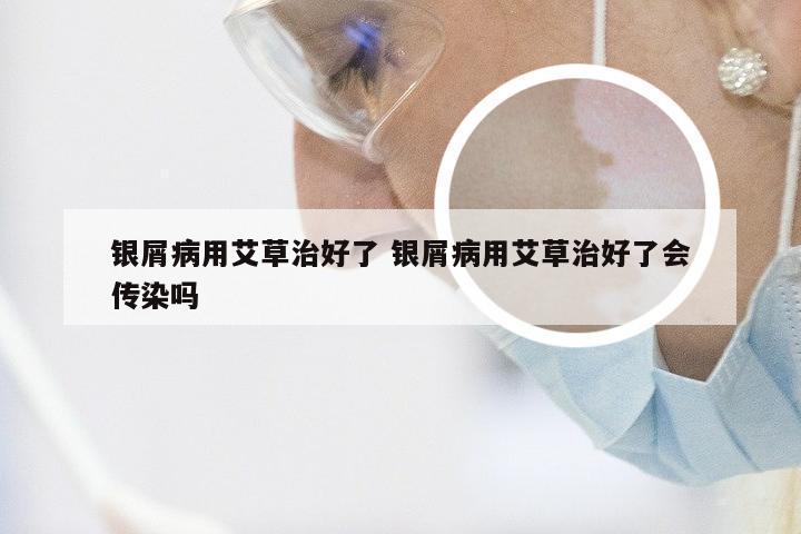 银屑病用艾草治好了 银屑病用艾草治好了会传染吗
