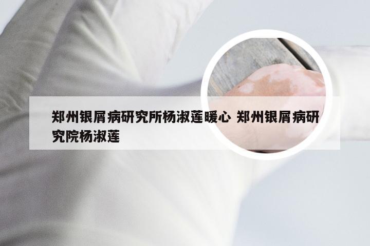 郑州银屑病研究所杨淑莲暖心 郑州银屑病研究院杨淑莲