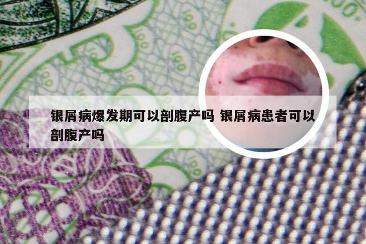 银屑病爆发期可以剖腹产吗 银屑病患者可以剖腹产吗