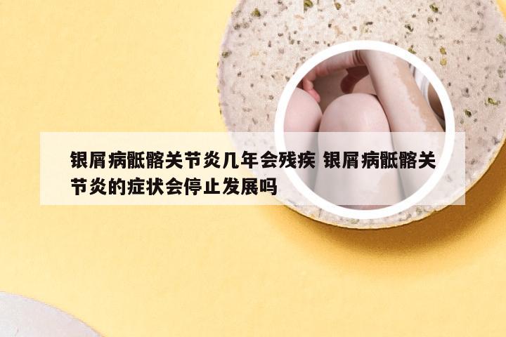 银屑病骶髂关节炎几年会残疾 银屑病骶髂关节炎的症状会停止发展吗