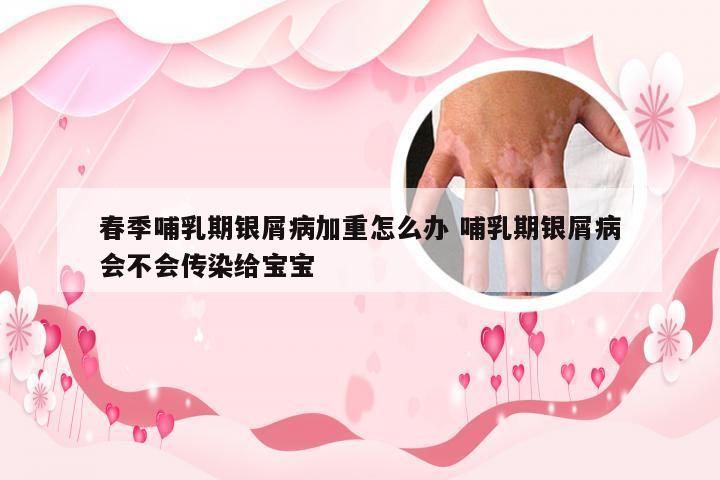 春季哺乳期银屑病加重怎么办 哺乳期银屑病会不会传染给宝宝