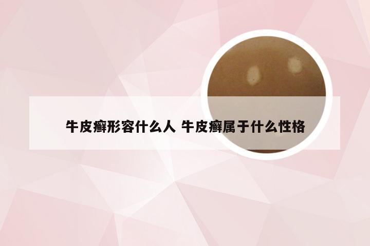 牛皮癣形容什么人 牛皮癣属于什么性格