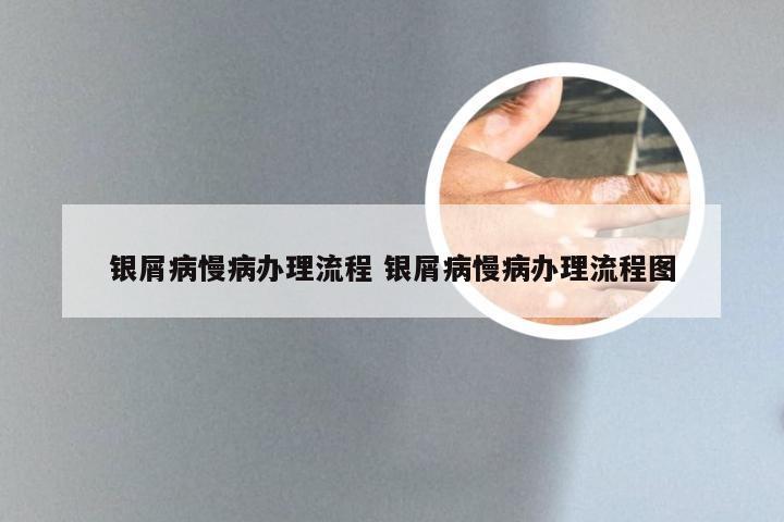 银屑病慢病办理流程 银屑病慢病办理流程图