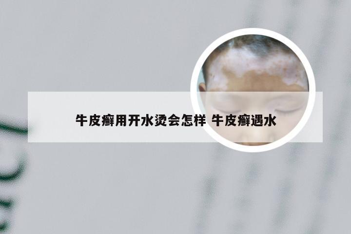 牛皮癣用开水烫会怎样 牛皮癣遇水