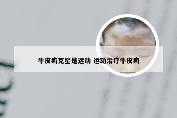 牛皮癣克星是运动 运动治疗牛皮癣