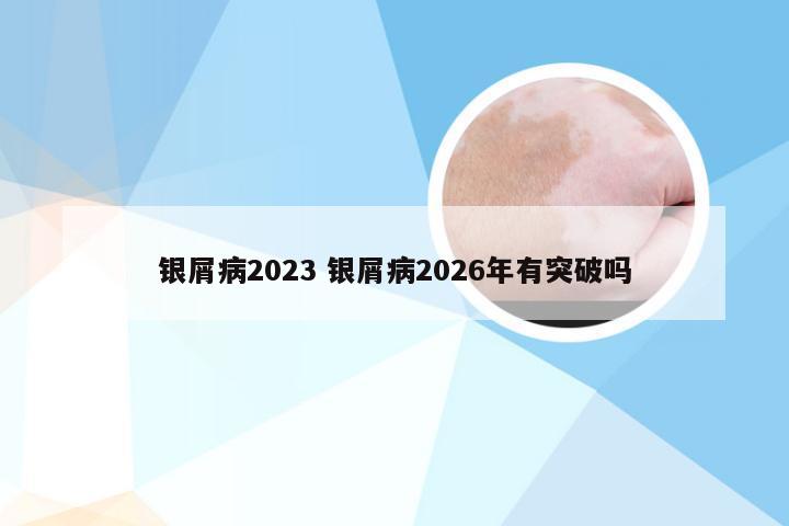 银屑病2023 银屑病2026年有突破吗