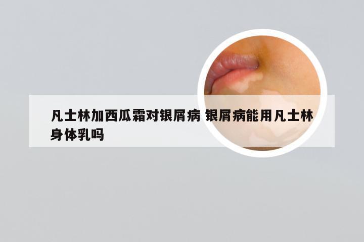 凡士林加西瓜霜对银屑病 银屑病能用凡士林身体乳吗