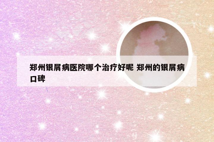 郑州银屑病医院哪个治疗好呢 郑州的银屑病口碑