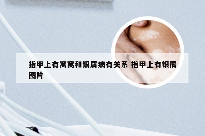 指甲上有窝窝和银屑病有关系 指甲上有银屑图片