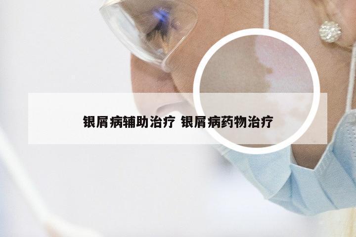 银屑病辅助治疗 银屑病药物治疗