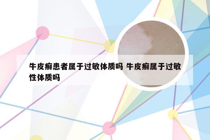 牛皮癣患者属于过敏体质吗 牛皮癣属于过敏性体质吗