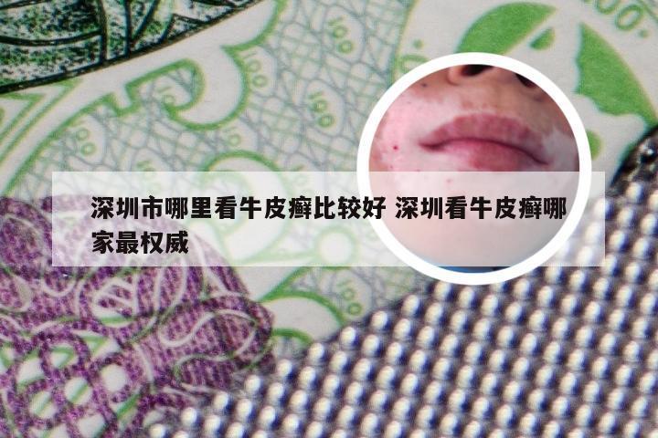 深圳市哪里看牛皮癣比较好 深圳看牛皮癣哪家最权威