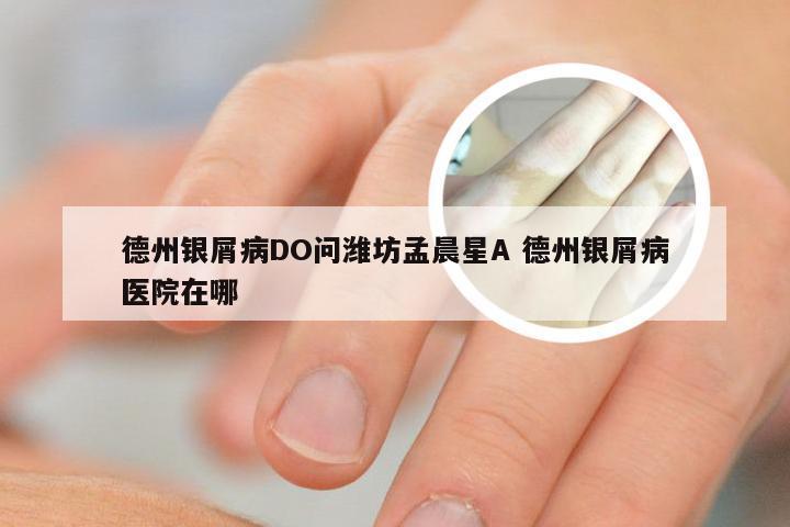 德州银屑病DO问潍坊孟晨星A 德州银屑病医院在哪