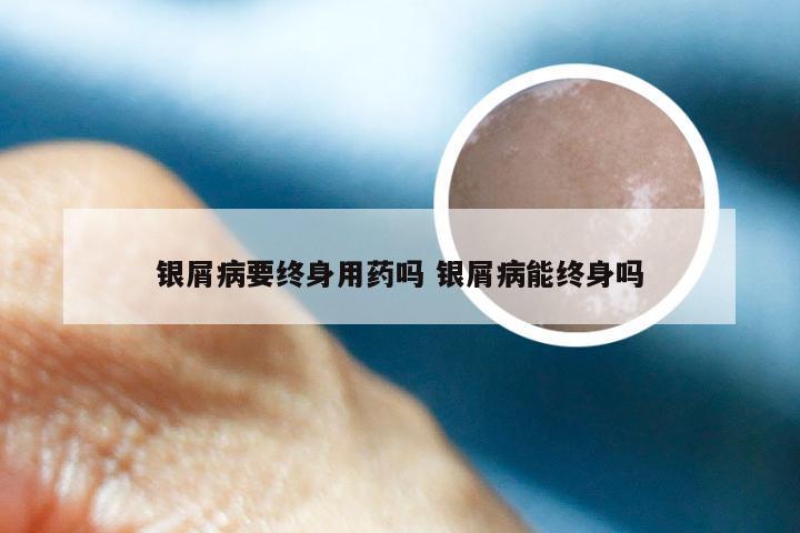 银屑病要终身用药吗 银屑病能终身吗