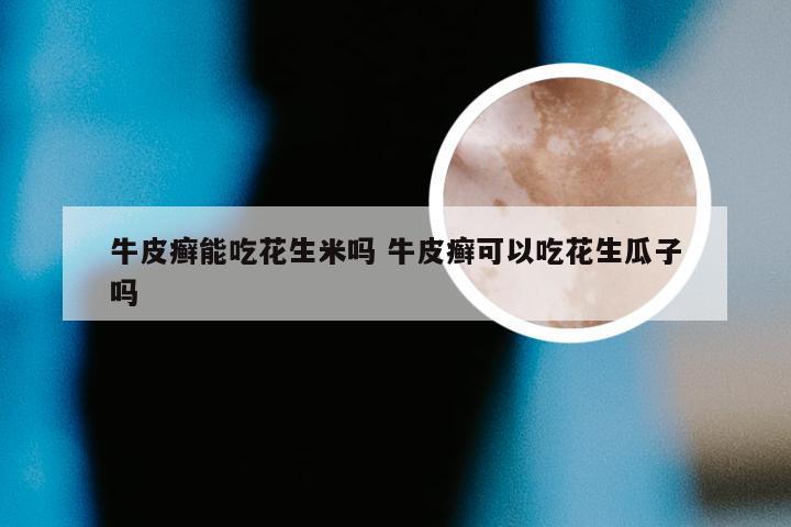 牛皮癣能吃花生米吗 牛皮癣可以吃花生瓜子吗