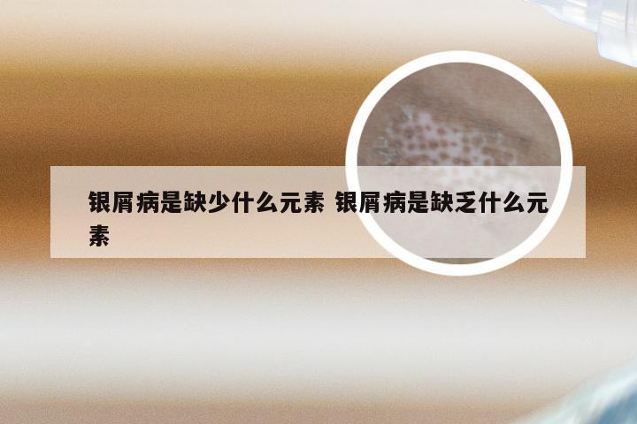 银屑病是缺少什么元素 银屑病是缺乏什么元素