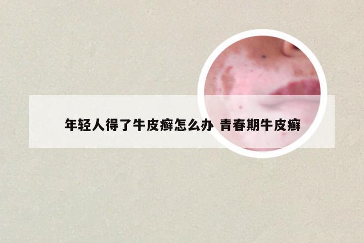 年轻人得了牛皮癣怎么办 青春期牛皮癣