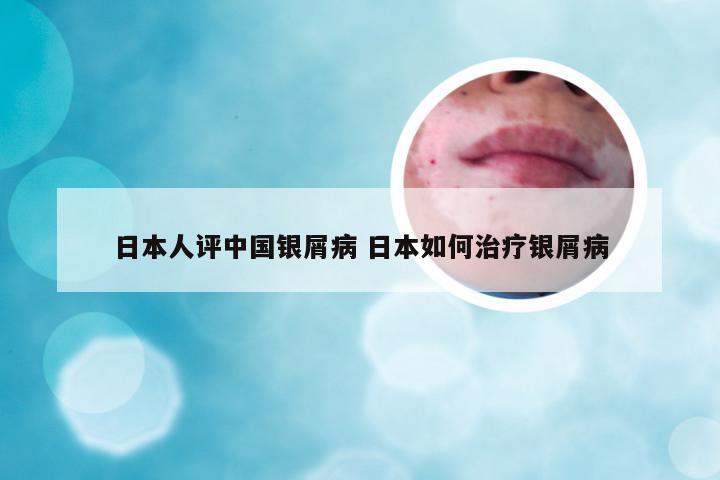 日本人评中国银屑病 日本如何治疗银屑病