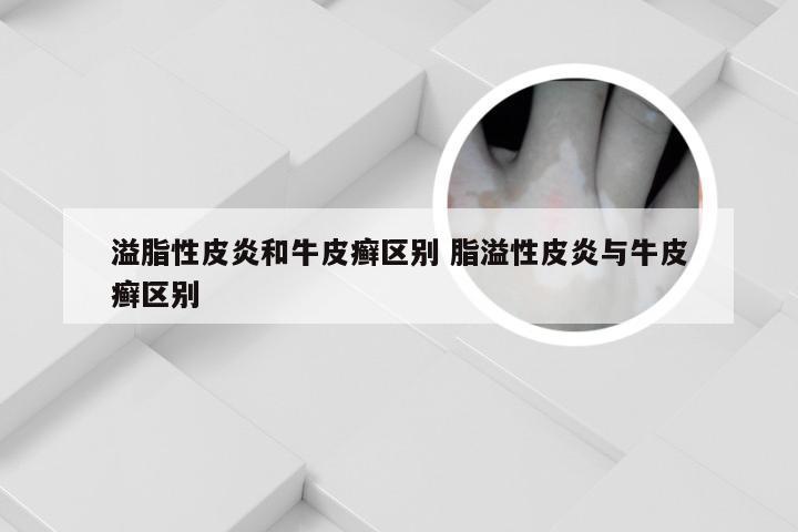 溢脂性皮炎和牛皮癣区别 脂溢性皮炎与牛皮癣区别