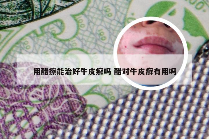 用醋擦能治好牛皮癣吗 醋对牛皮癣有用吗