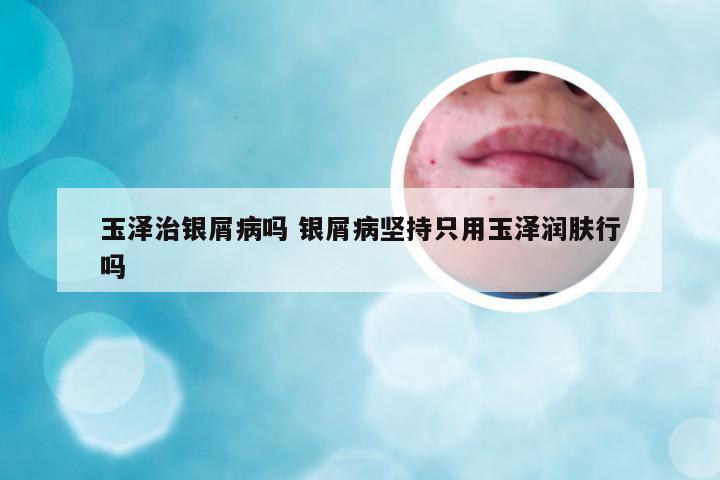 玉泽治银屑病吗 银屑病坚持只用玉泽润肤行吗