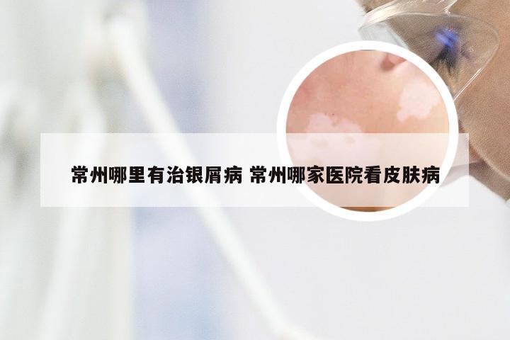 常州哪里有治银屑病 常州哪家医院看皮肤病