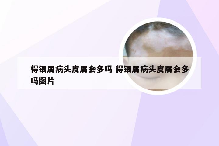 得银屑病头皮屑会多吗 得银屑病头皮屑会多吗图片