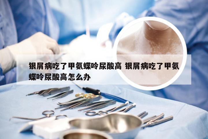 银屑病吃了甲氨蝶呤尿酸高 银屑病吃了甲氨蝶呤尿酸高怎么办