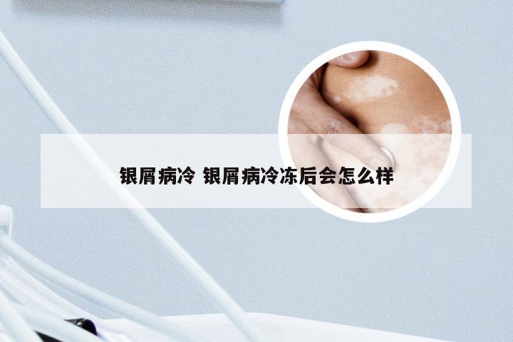 银屑病冷 银屑病冷冻后会怎么样