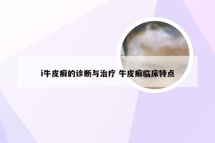 i牛皮癣的诊断与治疗 牛皮癣临床特点