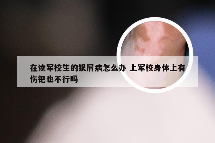 在读军校生的银屑病怎么办 上军校身体上有伤钯也不行吗
