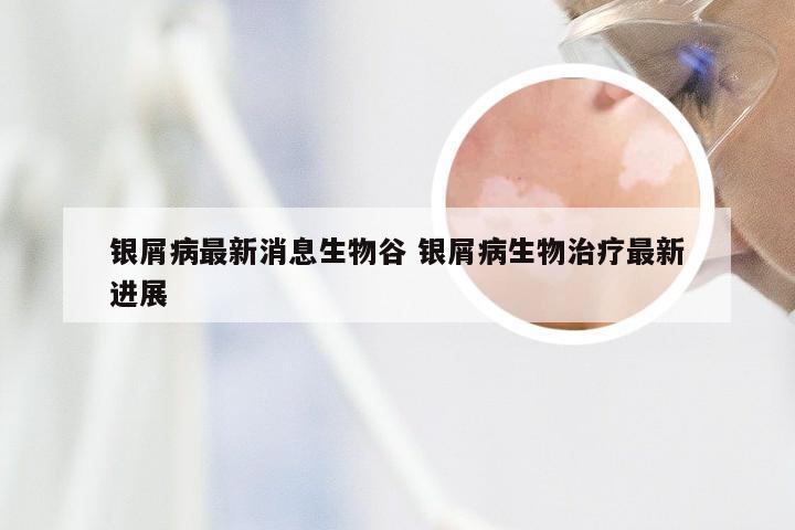 银屑病最新消息生物谷 银屑病生物治疗最新进展