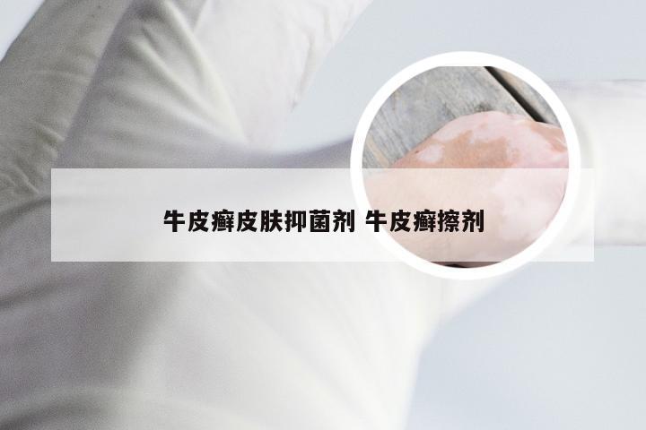 牛皮癣皮肤抑菌剂 牛皮癣擦剂