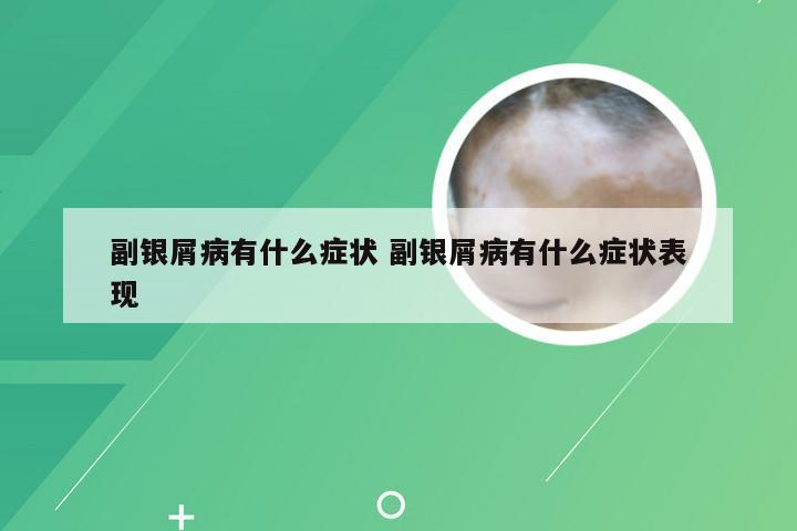 副银屑病有什么症状 副银屑病有什么症状表现