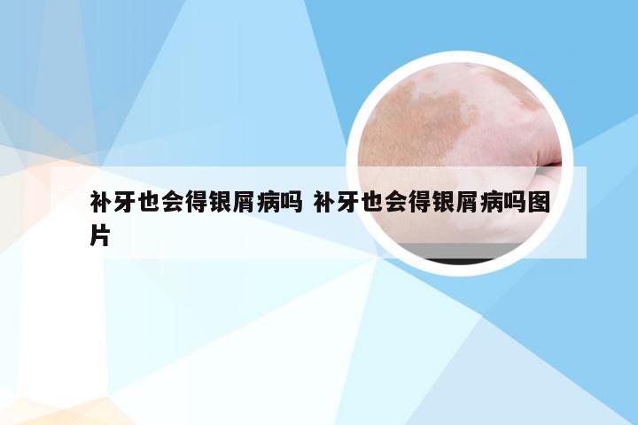 补牙也会得银屑病吗 补牙也会得银屑病吗图片