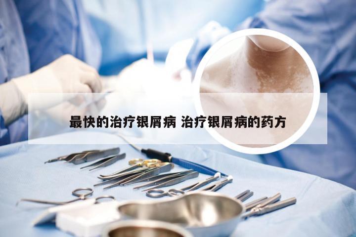 最快的治疗银屑病 治疗银屑病的药方