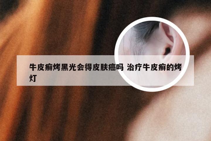 牛皮癣烤黑光会得皮肤癌吗 治疗牛皮癣的烤灯