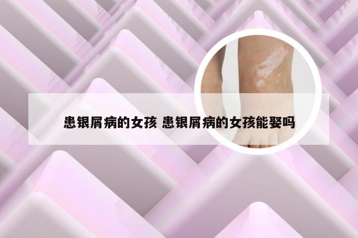 患银屑病的女孩 患银屑病的女孩能娶吗