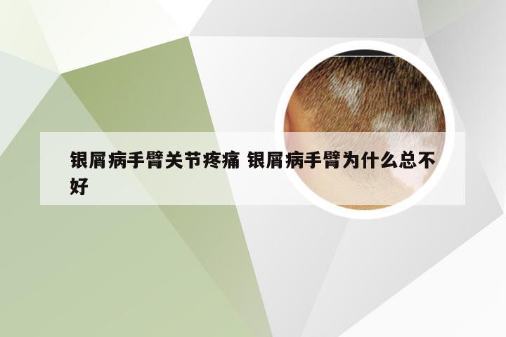 银屑病手臂关节疼痛 银屑病手臂为什么总不好