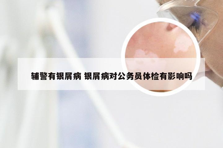 辅警有银屑病 银屑病对公务员体检有影响吗