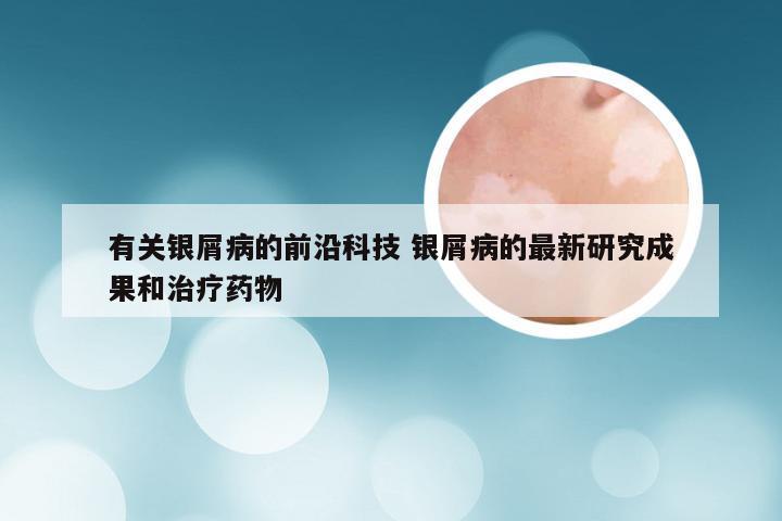 有关银屑病的前沿科技 银屑病的最新研究成果和治疗药物