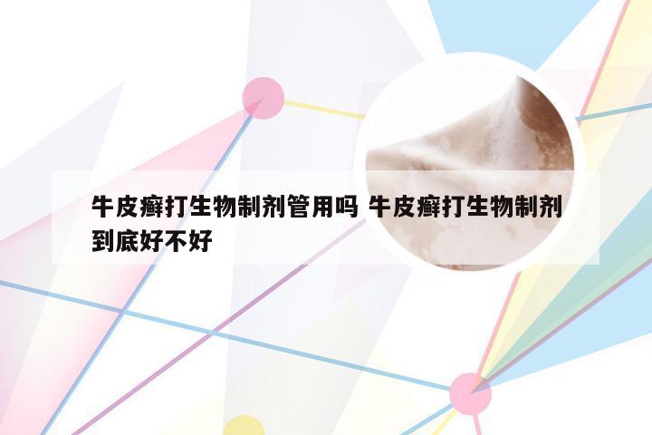 牛皮癣打生物制剂管用吗 牛皮癣打生物制剂到底好不好