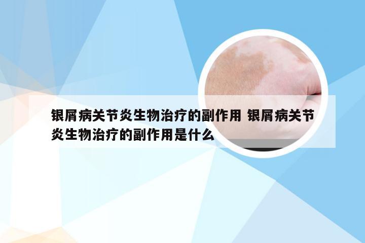 银屑病关节炎生物治疗的副作用 银屑病关节炎生物治疗的副作用是什么