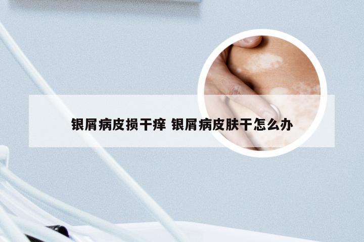 银屑病皮损干痒 银屑病皮肤干怎么办