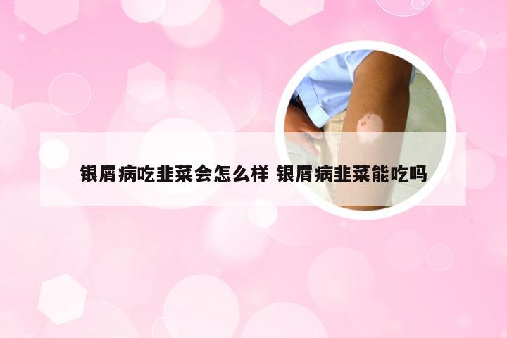 银屑病吃韭菜会怎么样 银屑病韭菜能吃吗