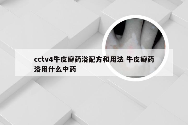 cctv4牛皮癣药浴配方和用法 牛皮癣药浴用什么中药