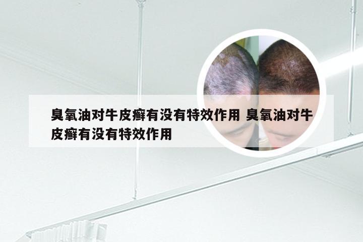 臭氧油对牛皮癣有没有特效作用 臭氧油对牛皮癣有没有特效作用