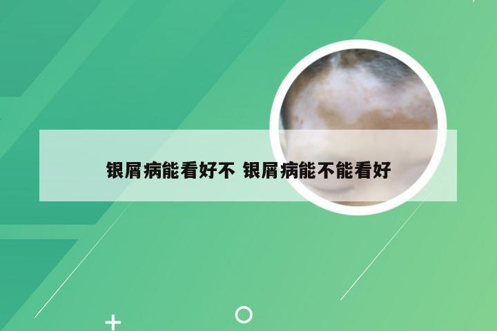 银屑病能看好不 银屑病能不能看好